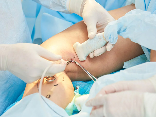 Ablacion quimica endovascular