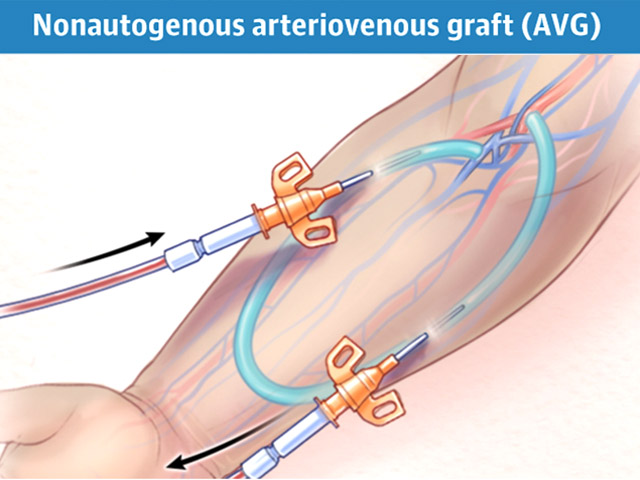 Hemodialisis Fistula Arterio Venosa