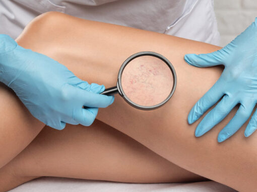 diagnostico_varices