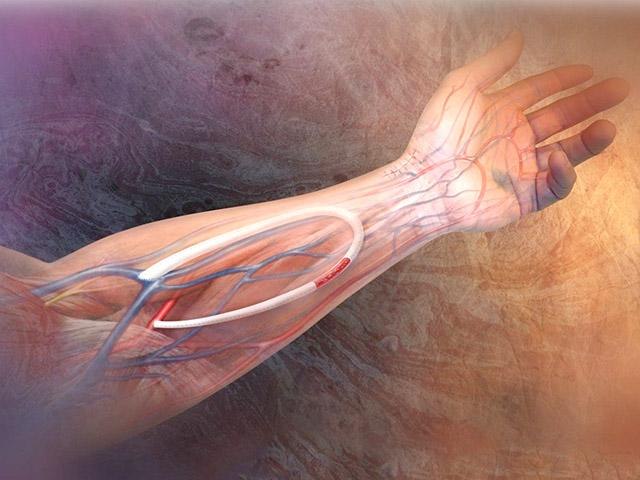 Fistula Arterio Venosa Fistula Arterio Venosa