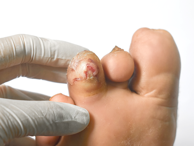 Lesion en pie del diabetico
