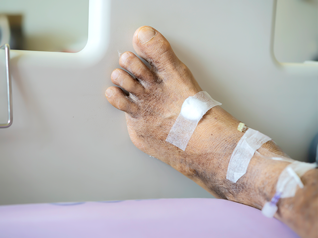 Lesiones graves en pie del diabetico con amputacion de un dedo