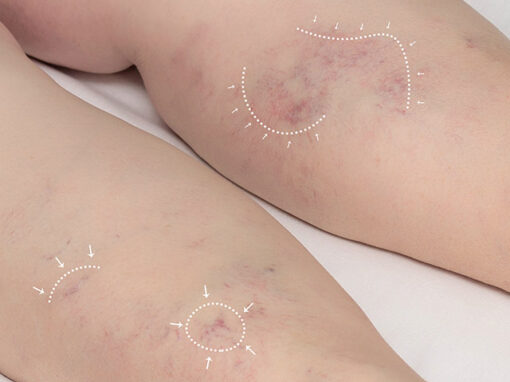piernas_vascular_plan