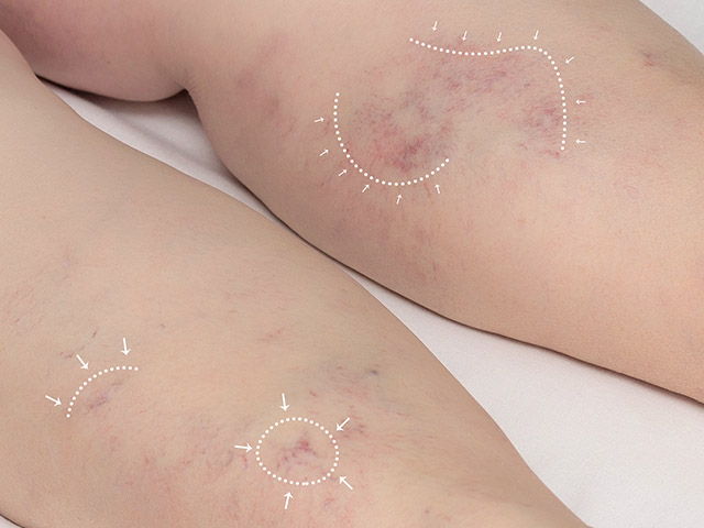 Plan de Tratamiento Vascular en Piernas