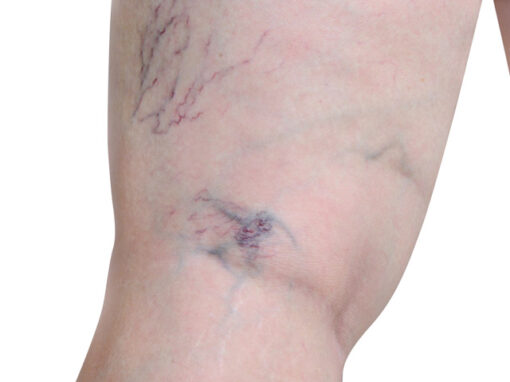 Varices_1