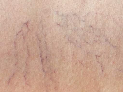 Varices_2