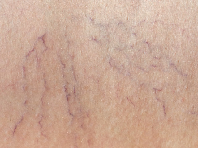 Hemodialisis Fistula Arterio Venosa