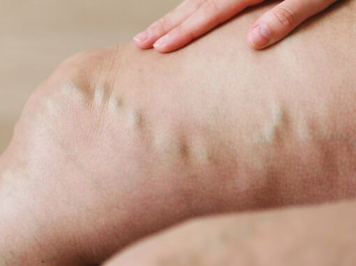 varices_grandes_1