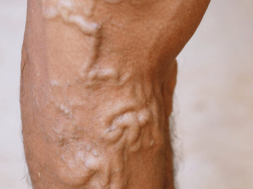 Varices_grandes_2