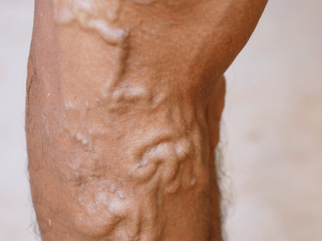 Varices de gran calibre